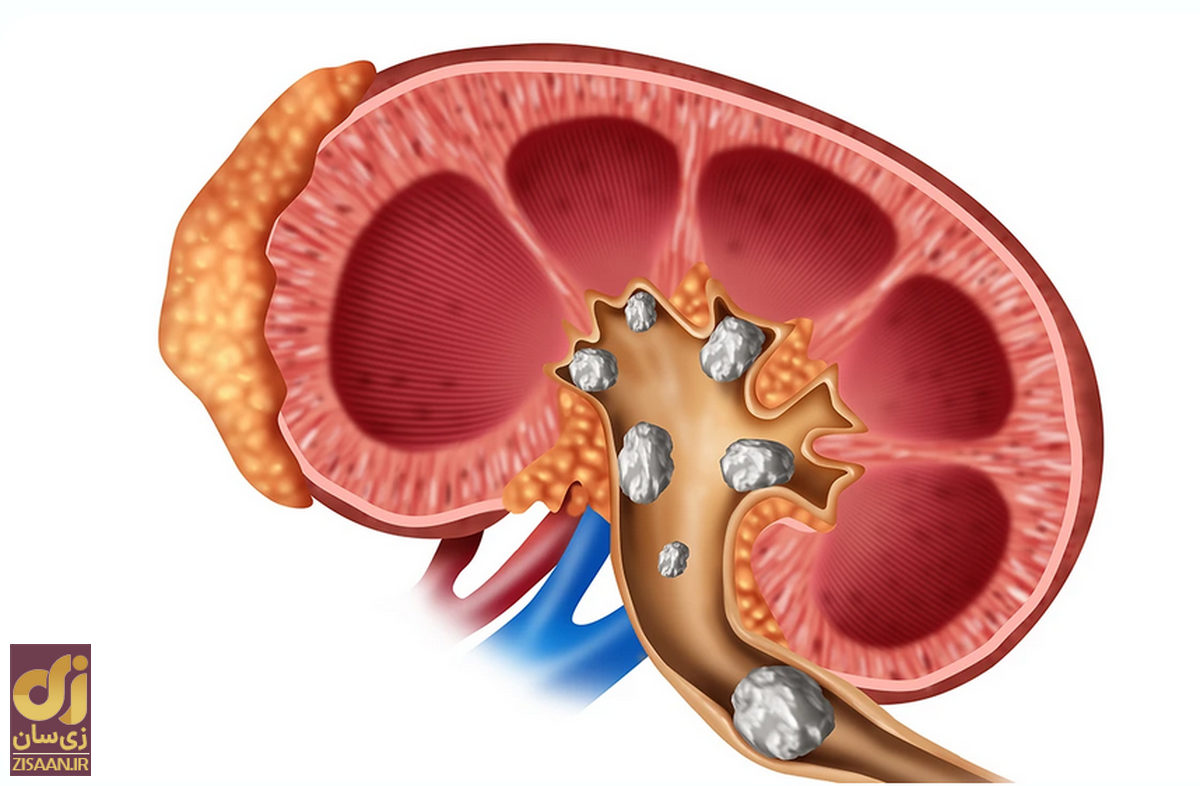 (ویدئو) سنگ‌ کلیه چگونه تشکیل می‌شود؟ از نزدیک ببینید!
