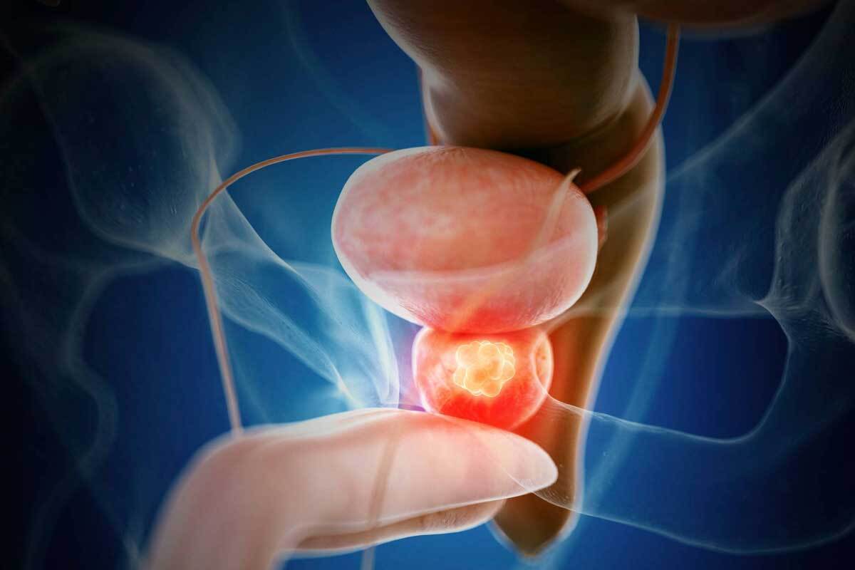 اصلی‌ترین دلیل شیوع سرطان پروستات را می‌دانید؟