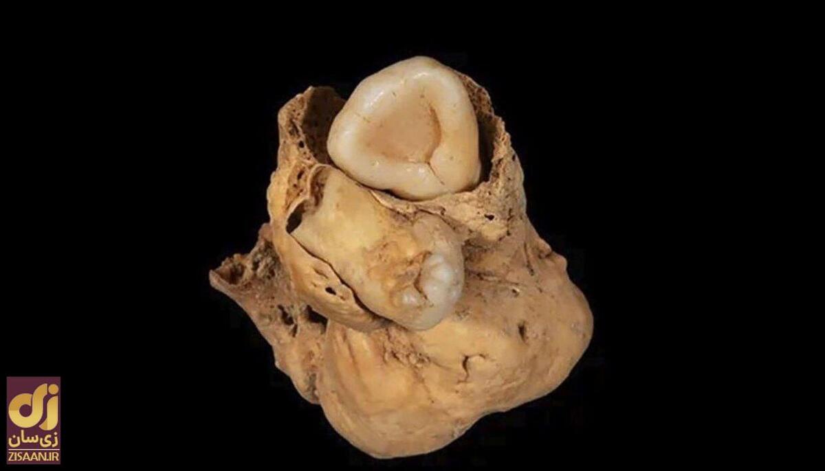محققان در فسیل ۳۰۰۰ ساله یک زن مصری، توموری عجیب با دو دندان کشف کردند!