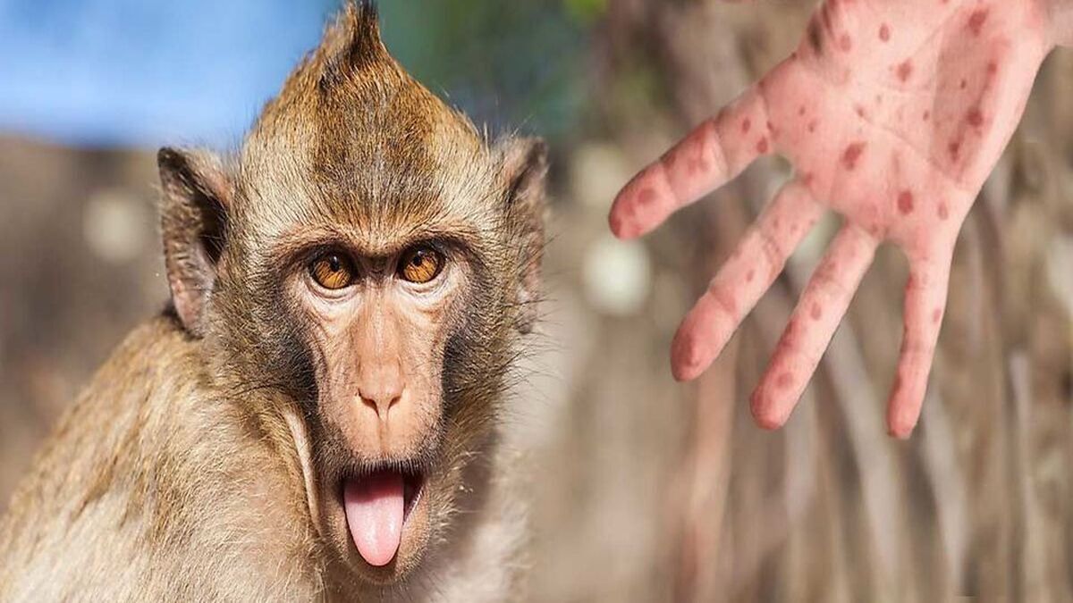 عکس آبله میمون در ایران