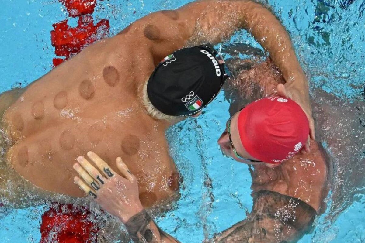 چرا شناگران المپیک به بادکش درمانی علاقمندند؟