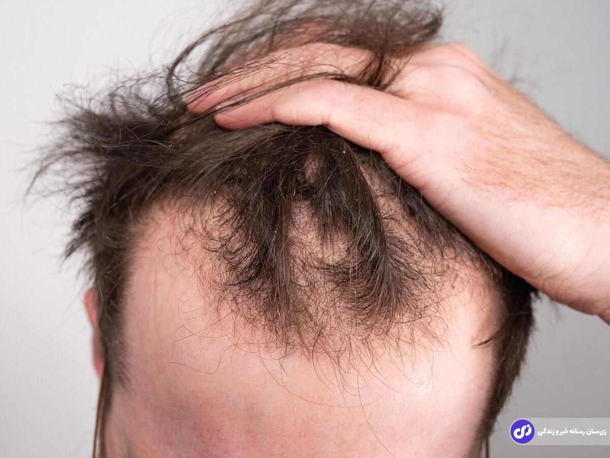 هشدار به مردان درباره این داروی ریزش مو پرطرفدار؛ سلامت جنسی شما در خطر است!